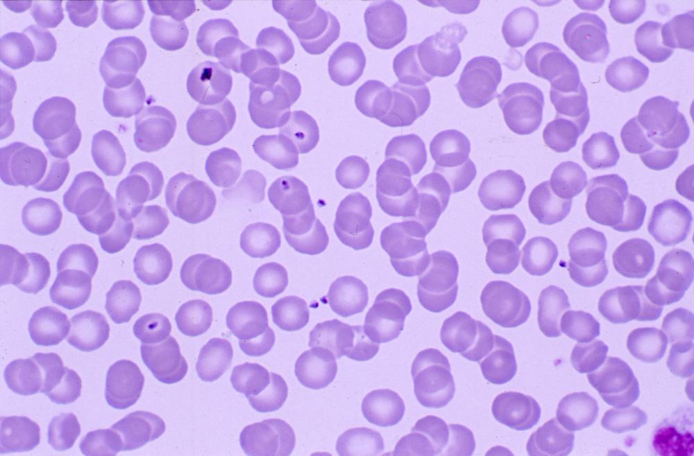 Malarial merozoites in the peripheral blood.